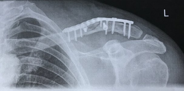 Clavicula.jpg Clavicula.jpg